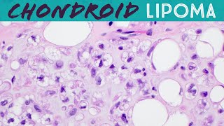 Chondroid lipoma has lipoblasts but not liposarcoma Basic soft tissue pathology [upl. by Galan]