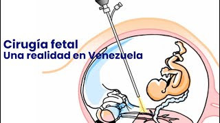 Cirugía fetal Una realidad en Venezuela [upl. by Edahsalof]