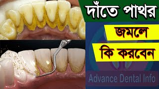 দাঁতের পাথর দূর করার উপায়  Date Pathor Dur Korar Upay  Teeth Stone Removal At Home In Bangla [upl. by Ayanat28]