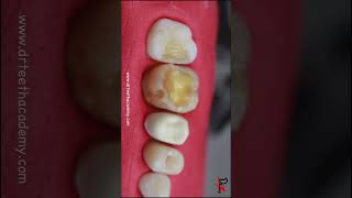 Renewing old teeth filling toothcavity cavityfilling [upl. by Garate]