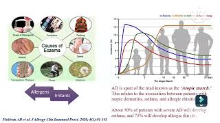 Atopic dermatitis diagnosis amp assessment Prof Ghada Shousha Pediatric immunology amp allergy Ain Shams [upl. by Oiciruam]