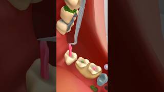 teeth cleaning  treatment animation video kidsvideo animationvideo asmrvideo shortvideo [upl. by Emmett]