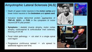 Amyotrophic Lateral Sclerosis ALS  Basics amp Clinical Presentation [upl. by Hakvir]