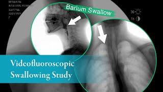 Barium Swallow Barium Esophagram AnteriorPosterior View [upl. by Aisnetroh593]