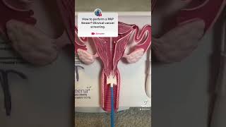 PAP Smear demonstration for Cervical cancer screening MEDICAL TIPS [upl. by Warrenne825]