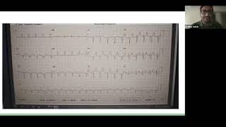 04 07 2024 Case Presentation Cirrhotic Patient for Right Hepatectomy [upl. by Inoliel]