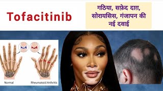 Tofacitinib गठिया सफ़ेद दाग़ सोरायसिस गंजापन की नई दवाई Rheumatoid Arthritis Psoriasis Vitiligo [upl. by Tram539]