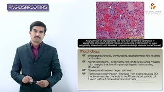 Vascular tumors  Angiosarcoma  Definition Epidemiology Pathology Diagnosis and treatment [upl. by Eelrahs]