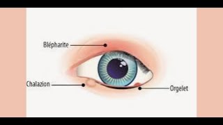 Chalazion vs orgelet [upl. by Aicnelav133]