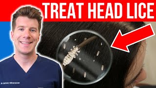 How to TREAT HEAD LICE AND NITS  Doctors stepbystep guide [upl. by Mcquoid322]