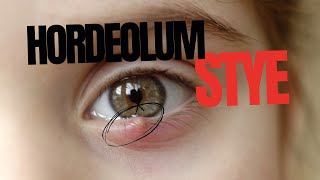 Stye Hordeolum [upl. by Arretahs]