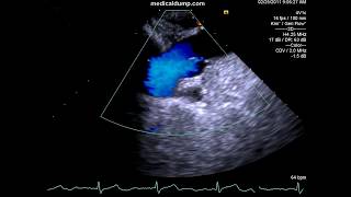 Aortic Dissection  TransEsophageal Echocardiography TEE [upl. by Davida]