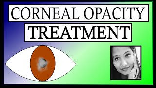 Treatment of Corneal Opacity  Keratoplasty PTK OI Tattooing Contact lenses [upl. by Ihel]