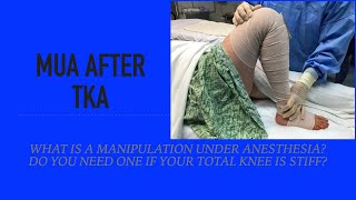 Manipulation Under Anesthesia MUA after Total Knee  Treatment for Stiffness [upl. by Lesna]