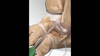 Ankle sprain repair  animationshorts shortsfeed youtubeshorts viralshorts [upl. by Eedoj]