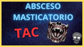 ABSCESO MASTICATORIO 🤐 Hallazgos Radiológicos [upl. by Groscr]