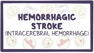 Hemorrhagic stroke intracerebral hemorrhage  causes symptoms diagnosis treatment pathology [upl. by Calen117]