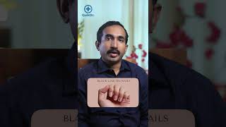 നഖത്തിൽ കാണുന്ന പാടുകൾ അപകടമാണോ  Black Lines and White Spots on Nails [upl. by Sieracki]