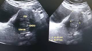 Subserosal fibroid [upl. by Bartholemy717]