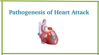 Pathogenesis of myocardial infarction  Heart Attack  Cardiovascular system pathology  Dr Med [upl. by Donelson]