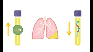 Empyema and Pleural Effusions [upl. by Engeddi]