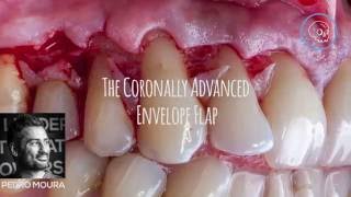 The coronally advanced flap [upl. by Romeu618]