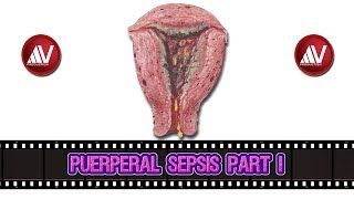 Puerperal Sepsis Part I [upl. by Olodort]