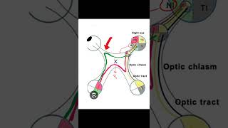 Junctional Scotoma insightophthalmology visual field ophthalmology [upl. by Moynahan957]