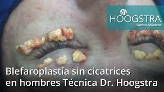 Blefaroplastía sin cicatrices en hombres Técnica Dr Hoogstra 18239 [upl. by Hallagan]