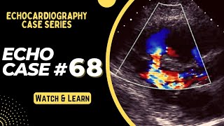 Echocardiography Case 68 Echo Spot Diagnosis Series  Echo Interpretation Made Easy [upl. by Llenyt]