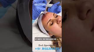 Best Clinic for Microneedling Treatment  BodyClinix [upl. by Thurstan]