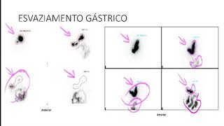 CINTILOGRAFIA ABDOMINAL [upl. by Gallager]