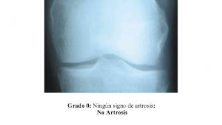 Artrosis de rodilla graduación radiologica Dr Carlos fernández López CHUAC A Coruña Spain [upl. by Norvin]