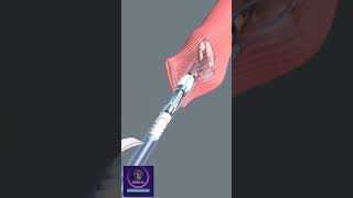 Laparoscopic Esophageal Surgery [upl. by Atirehc]