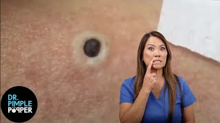 85 Year Old Blackhead Dr Pimple Popper Most Popular Pop of ALL TIME [upl. by Alodie]