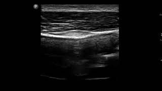 Knee Ultrasound Iliotibial IT Band Injection [upl. by Damha]