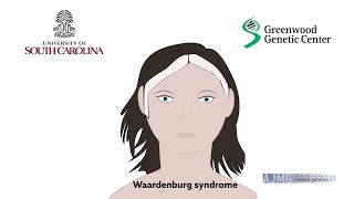 Biallelic deletions of the Waardenburg II syndrome gene SOX10 cause a recognizable arthrogryposis [upl. by Enram]