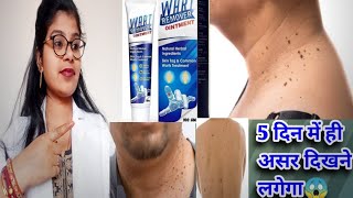 Wart Remover Ointment Honest Review2024Wart Remover ointment best usesampside effects review inhindi [upl. by Alaehs849]