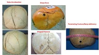 Head Injuries and medicolegal aspects  Part 1 Scalp fractures and intracranial haemorrhages [upl. by Cordie826]