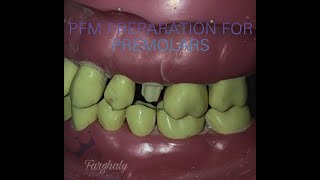 PFM winged preparation for upper 5 [upl. by Serilda629]