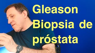 Que significa Gleason en la Biopsia de próstata [upl. by Astor]