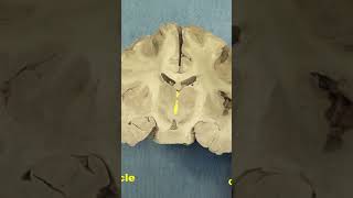 Caudal diencephalon Thalamus and subthalamusneuroanatomy forebrain anatomy brainhumanbrain [upl. by Imim]