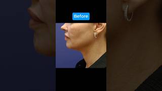 HUGE FACELIFT TRANSFORMATION [upl. by Rici874]