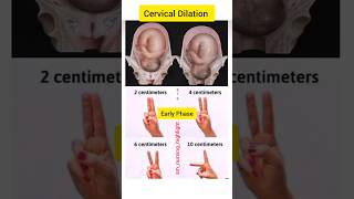 Cervical Dilation Measurement  Cervix Dilation  Cervix Length dilationchartphasemeasureshort [upl. by Kendy743]