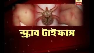 Scrub Typhus virus in Kolkata now [upl. by Edlitam]