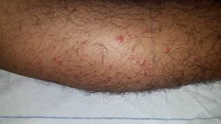 Palpable Purpura HSP  Henoch  Schonlein Purpura [upl. by Yenaiv]