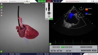 HeartWorks Atrial Septal Defect [upl. by Sigsmond]