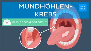 Mundhöhlenkrebs Ursachen Symptome Behandlung  Kenhub [upl. by Saitam404]