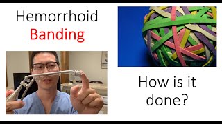 What is a hemorrhoid banding I show you how its done [upl. by Oleic]