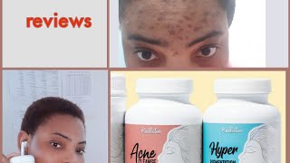 MY HONEST REVIEW ON KALLISTIA ACNE CLEANSE [upl. by Ahsikar142]